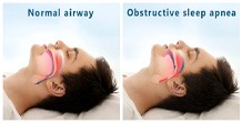 examples of normal airway and obstructive sleep apnea